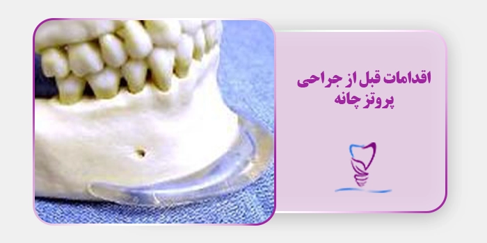 اقدامات قبل از جراحی پروتز چانه