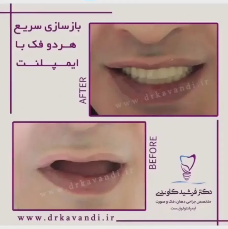 نمونه ایمپلنت دکتر فرشید کاوندی