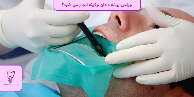 جراحی ریشه دندان چگونه انجام می شود؟