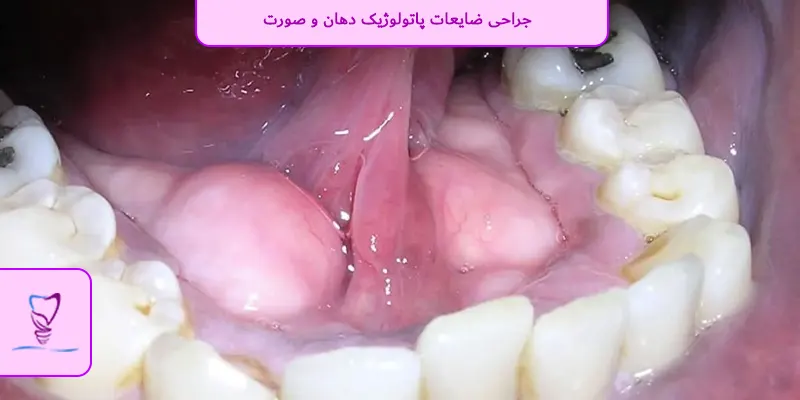 جراحی ضایعات پاتولوژیک دهان و صورت