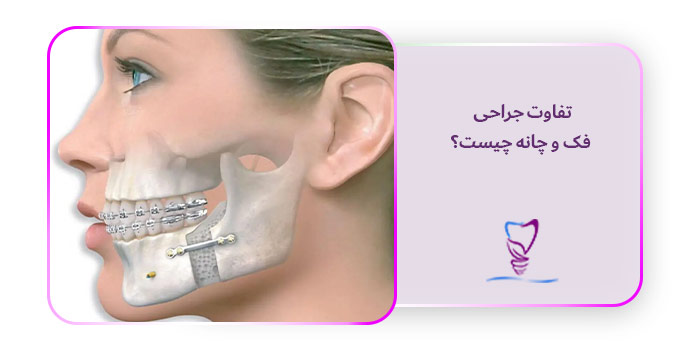 تفاوت جراحی فک و چانه چیست؟