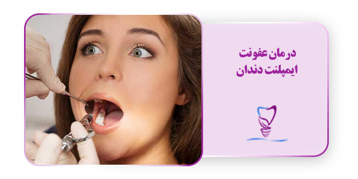 درمان عفونت ایمپلنت دندان