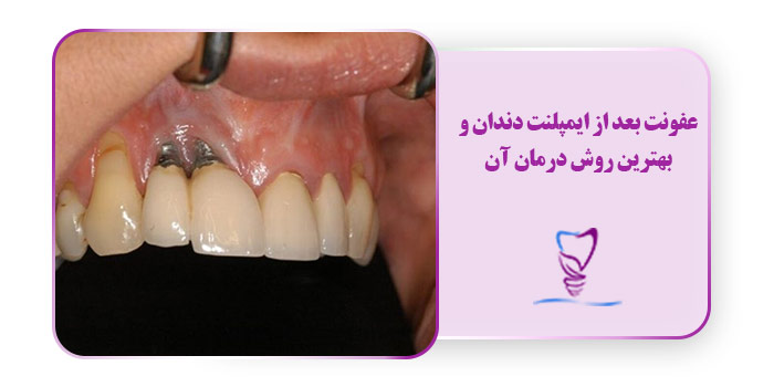 عفونت بعد از ایمپلنت دندان و بهترین روش درمان آن