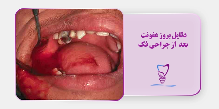 دلایل بروز عفونت بعد از جراحی فک