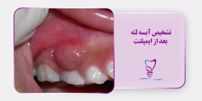 تشخیص آبسه لثه بعد از ایمپلنت