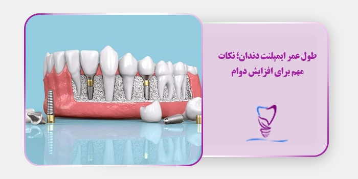 طول عمر ایمپلنت دندان؛ نکات مهم برای افزایش دوام