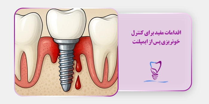 اقدامات مفید برای کنترل خونریزی پس از ایمپلنت