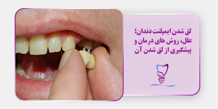 لق شدن ایمپلنت دندان؛ علل، روش های درمان و پیشگیری از لق شدن آن
